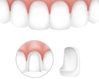 All You Need To Know About Veneers